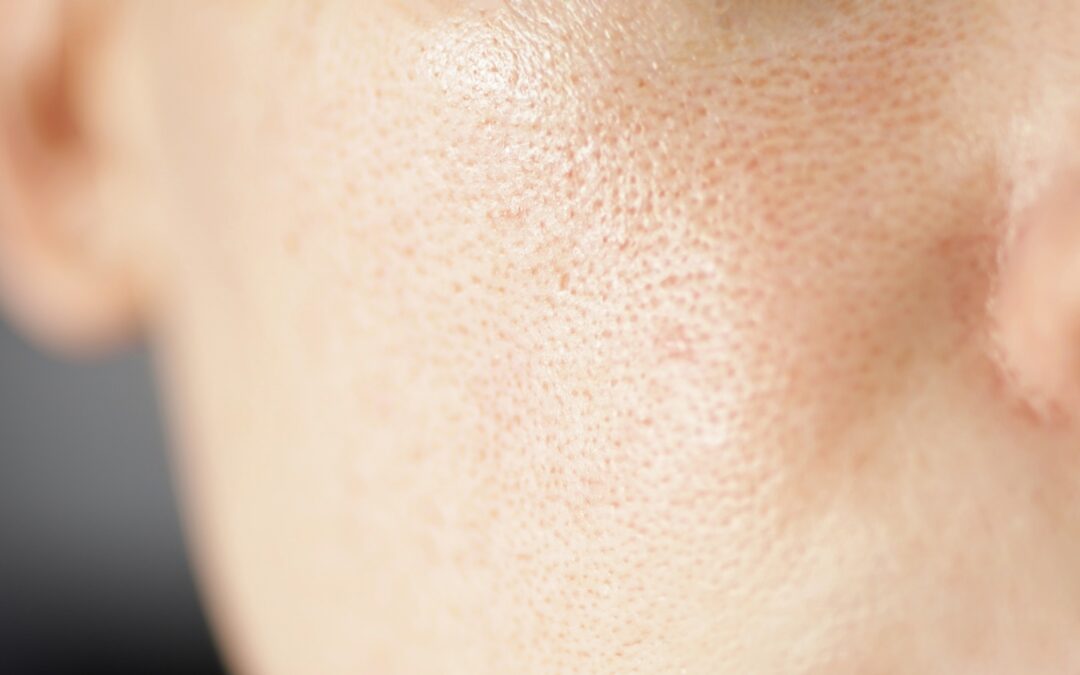 Things to Know About Clogged Pores